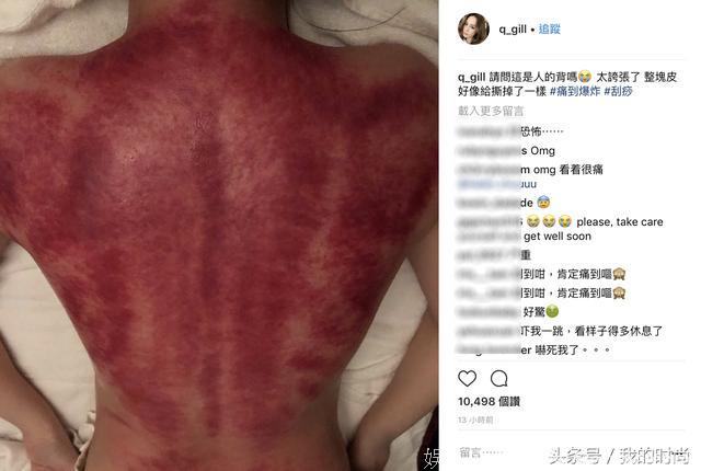 看见觉得疼！阿娇刮痧晒“血背照”：整块皮好像给撕掉了一样