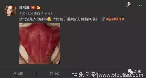 阿娇刮痧刮成“焦尸”，是刮得不对还是中医的锅？