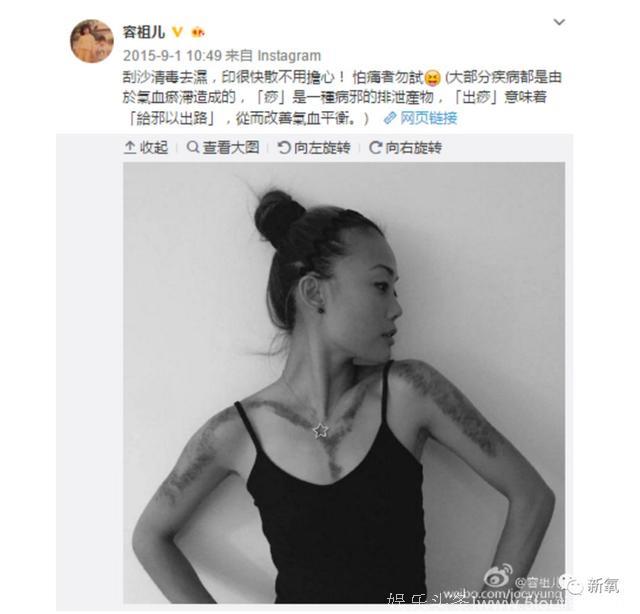 阿娇“血红后背照”吓哭网友！整块皮好像被撕掉！这样刮痧真不怕出事？