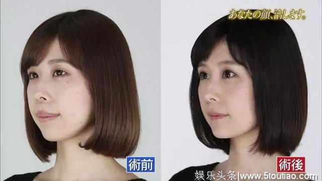 承认整容再也不丢脸？日本女生提出5大公开理由