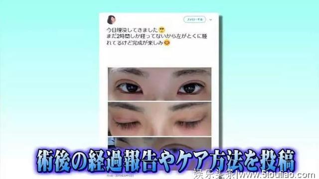 承认整容再也不丢脸？日本女生提出5大公开理由