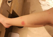 景甜晒美腿, 被蚊子叮个包都是爱你的形状